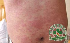 多年牛皮癬 2個療程治療擺脫病魔