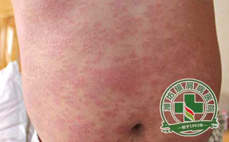 銀屑病治療