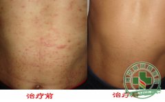 天津西站銀屑病醫院成功案例