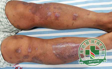 銀屑病護(hù)理