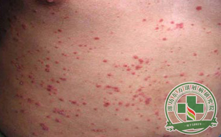 銀屑病預(yù)防